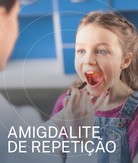 TRATAMENTO AMIGDALITE