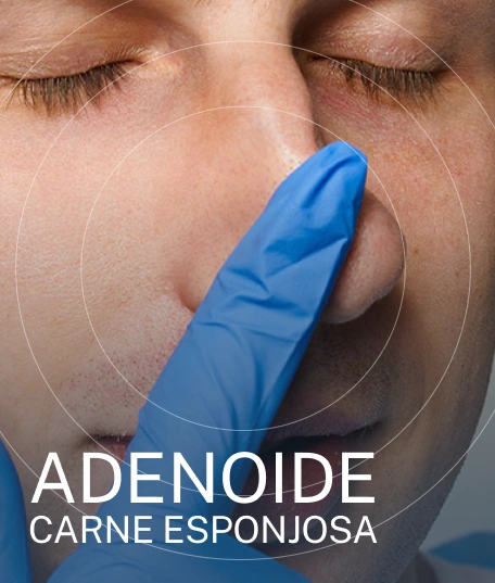 TRATAMENTO DA ADENOIDE